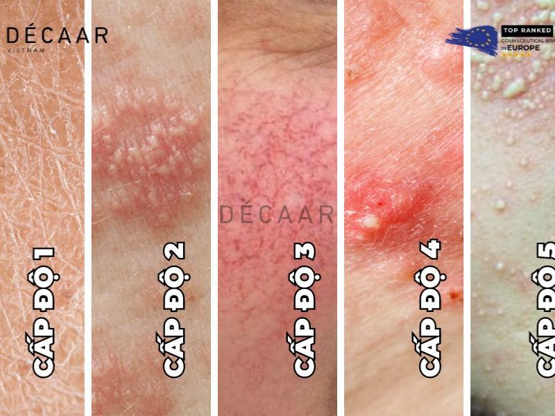 chất corticoid trong mỹ phẩm